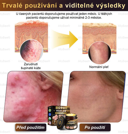 👨‍🔬AllyBee® Botox Krém na ošetření pleti proti stárnutí, hydratační, oprava pleti, vyrovnání tónu pleti, léčba akné a tmavých skvrn, odstraňování bradavic a mateřských znamének
