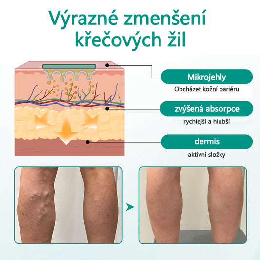 [Oficiální obchod značky]Timilk® Obnova nohou náplast na křečové žíly