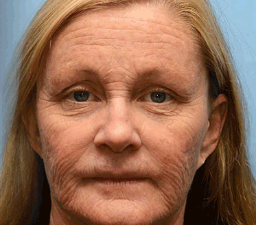 🔥🔥Vyrobeno a odesláno z Česká republika ✅ PLTOWE™ Botoxový včelím jedem odstranění vrásek krém - poslední den propagace 70% sleva